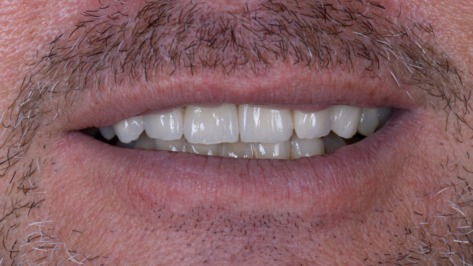 HeraCeram Keramik Arbeit Ergebnis Anprobe