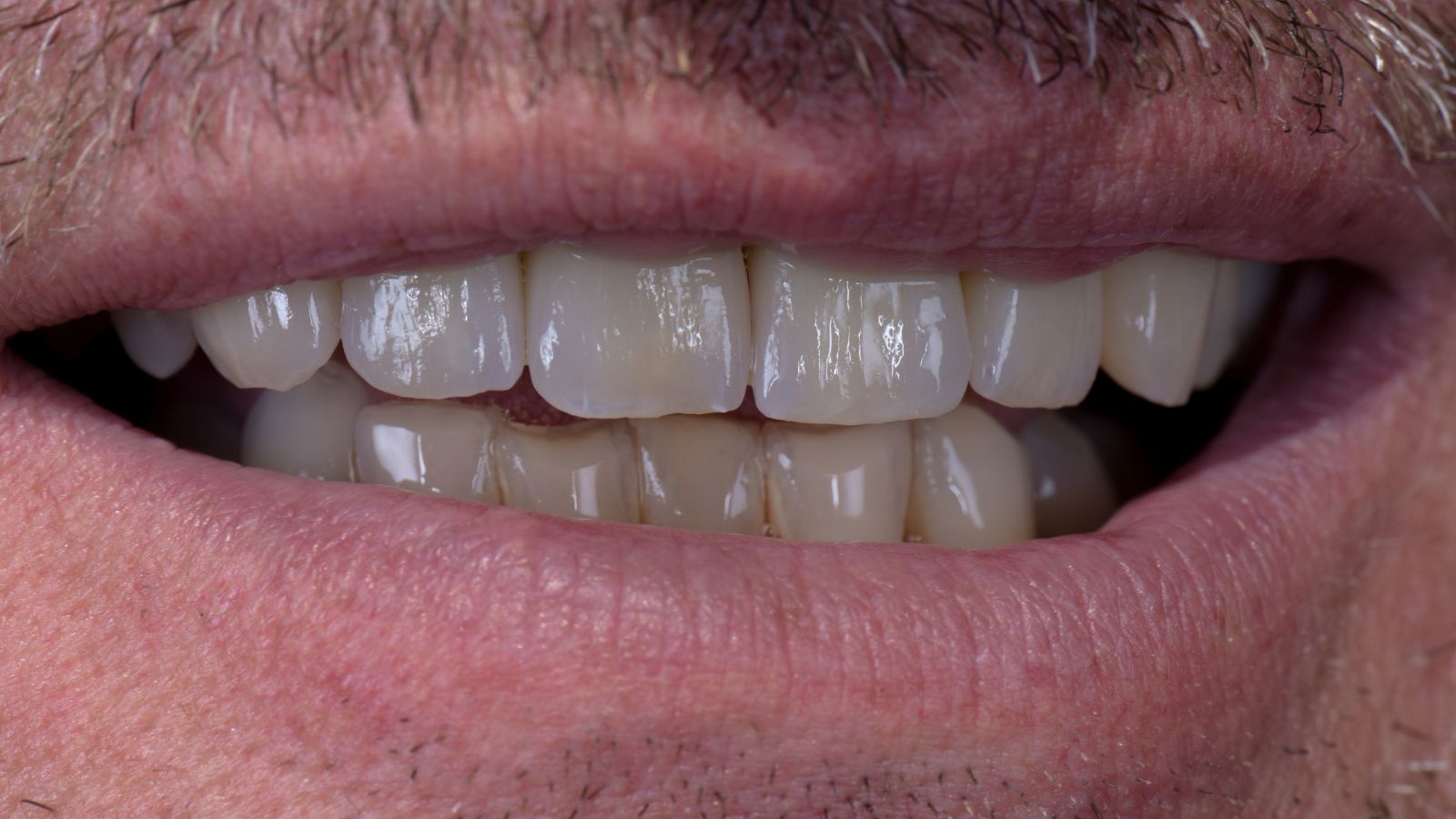 HeraCeram Keramik Arbeit Einprobe Patient