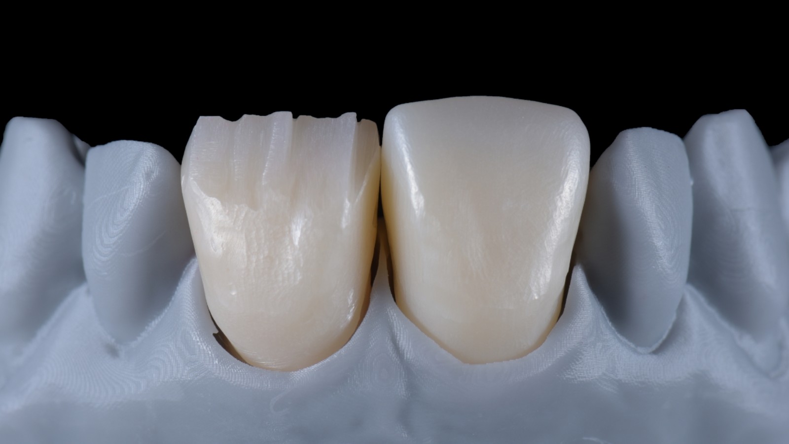 Keramische Verblendung in Microlayering-Technik und Vollkeramischer Zahnersatz im Vergleich