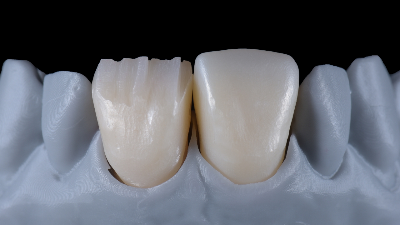 Keramische Verblendung in Microlayering-Technik und Vollkeramischer Zahnersatz im Vergleich