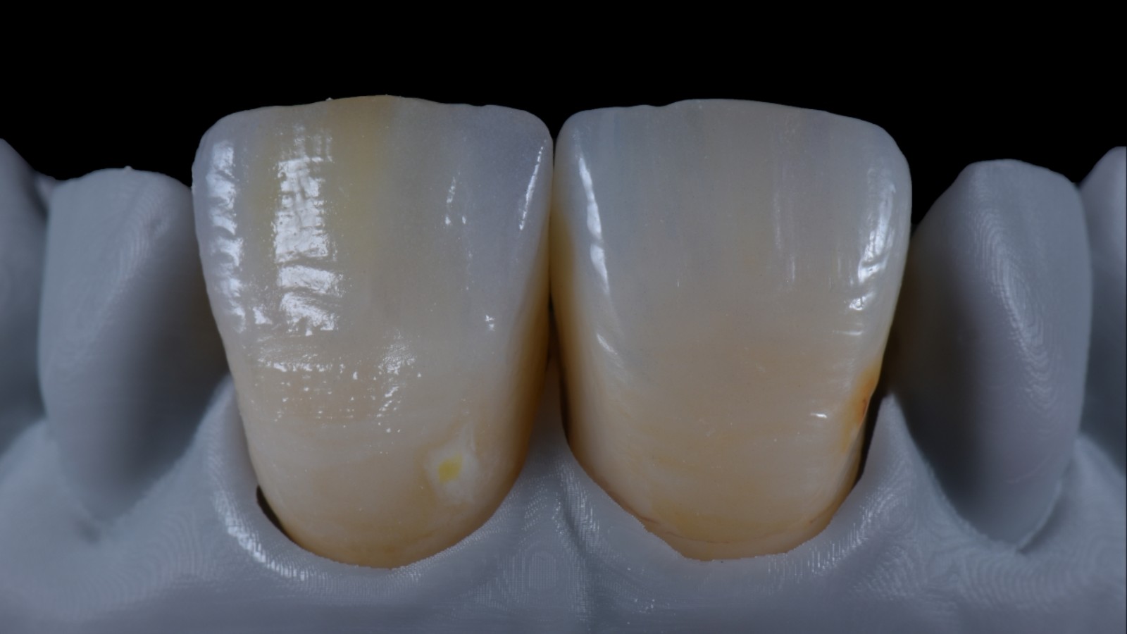 Microlayering vs. Bemalen in keramischer Prothetik 