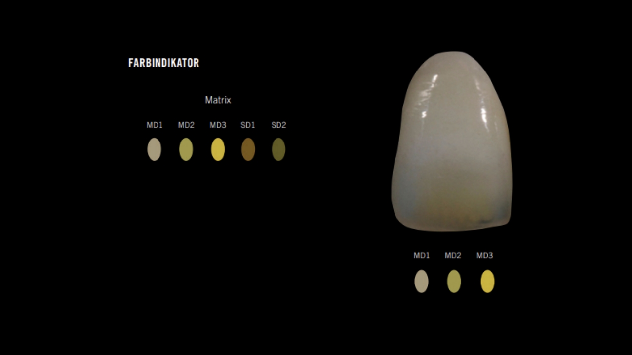 Mamelon- und Sekundär-Dentine balancieren Chroma und Fluoreszenz der Verblendung aus