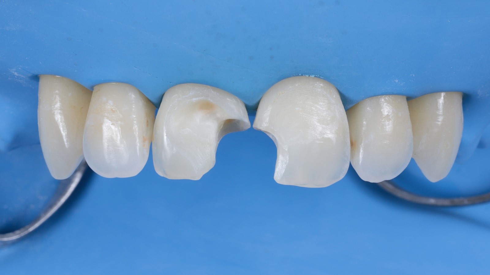 Removal of old composite