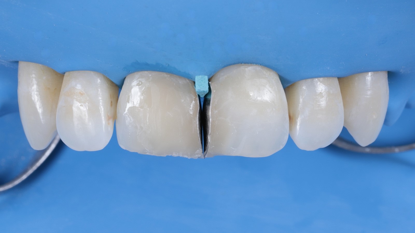 Reconstruction with Venus Pearl Pure Shades