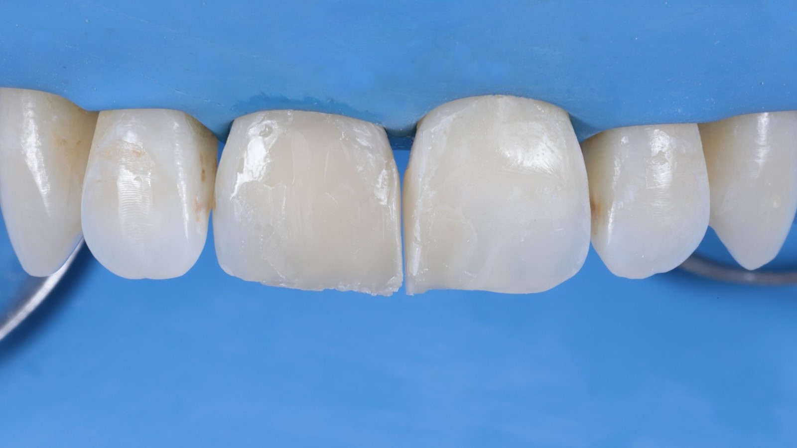 Restorations before finishing and polishing