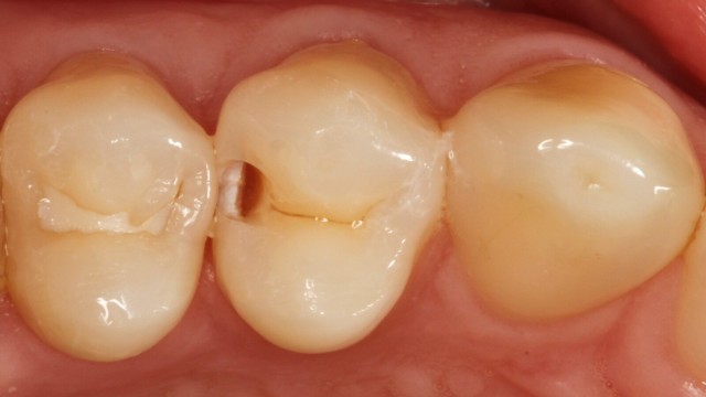 Opened caries lesion to show the problem to the patient.