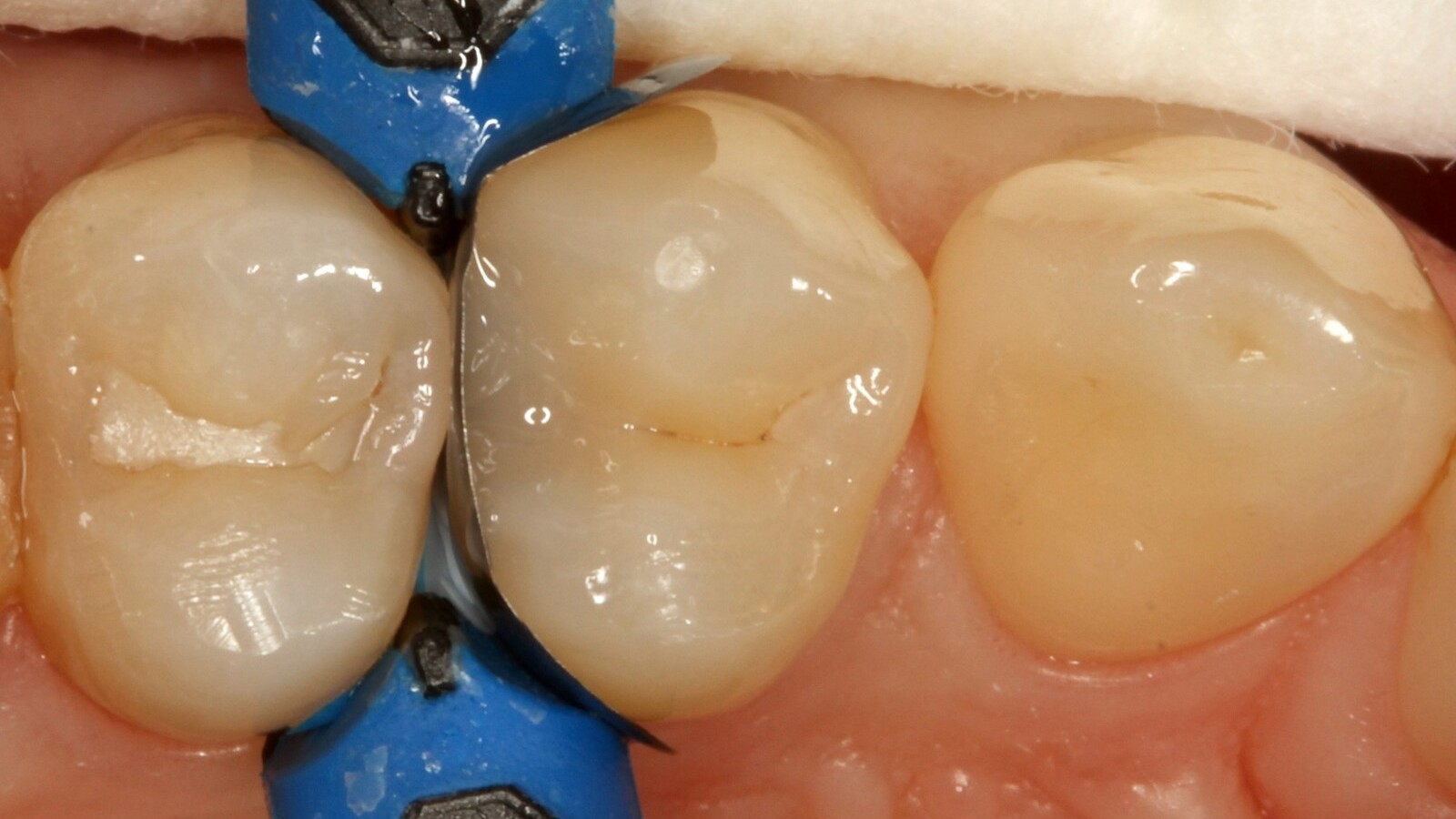 Restauration eines Zahnes mit Venus Bulk Flow ONE