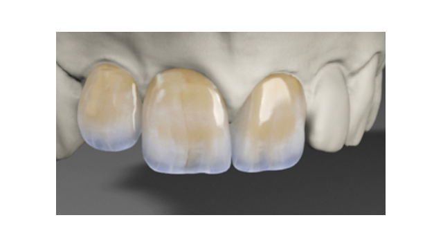 Keramische Versorgung