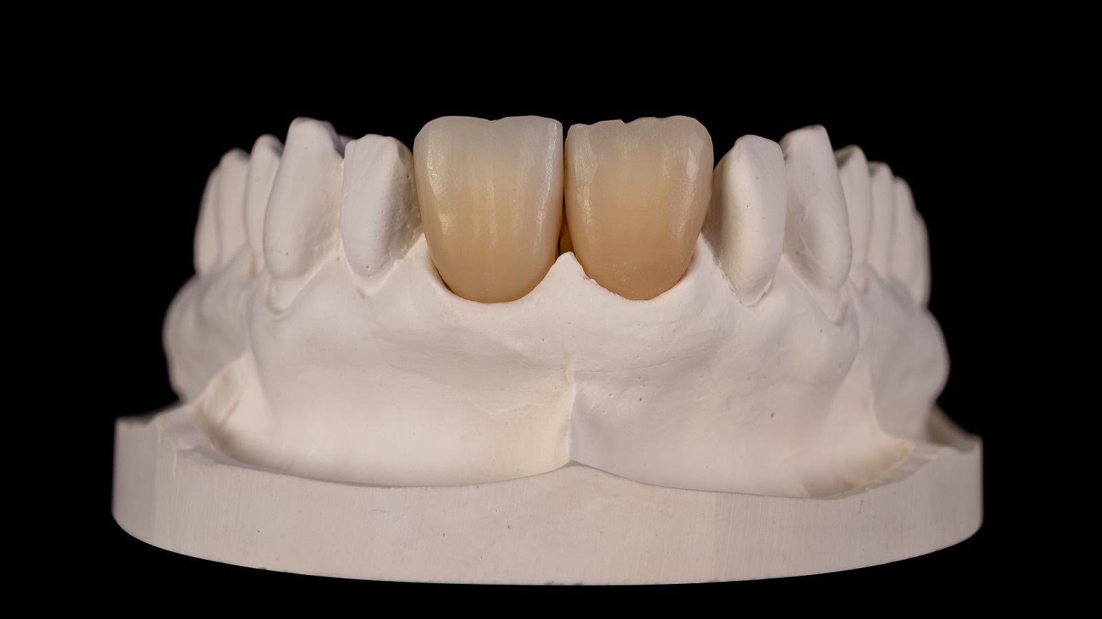 Minimal reduced zirconia multi-layer frame in A3