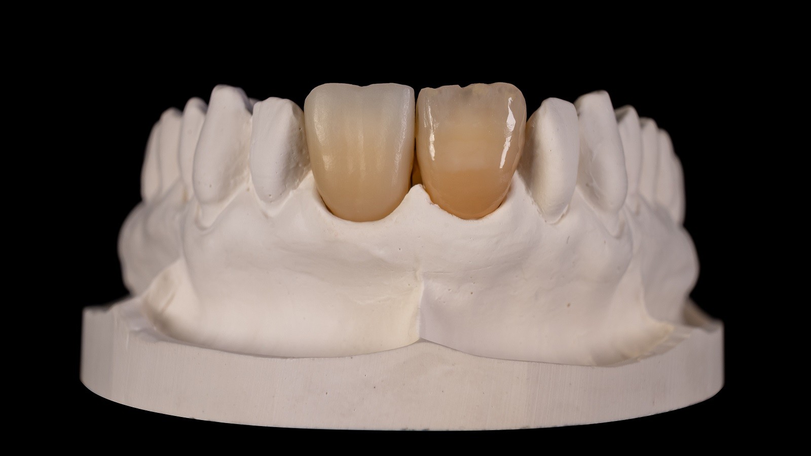 Result after HeraCeram cre-active 2D firing