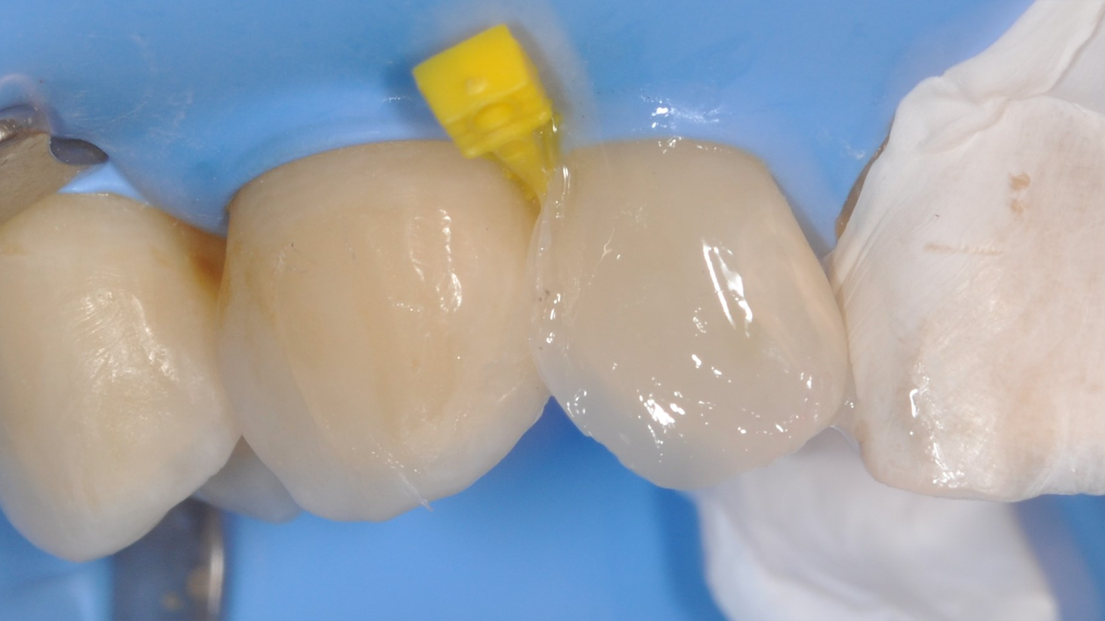 Layering with Venus Diamond MEDIUM and characterisation with Venus Color​