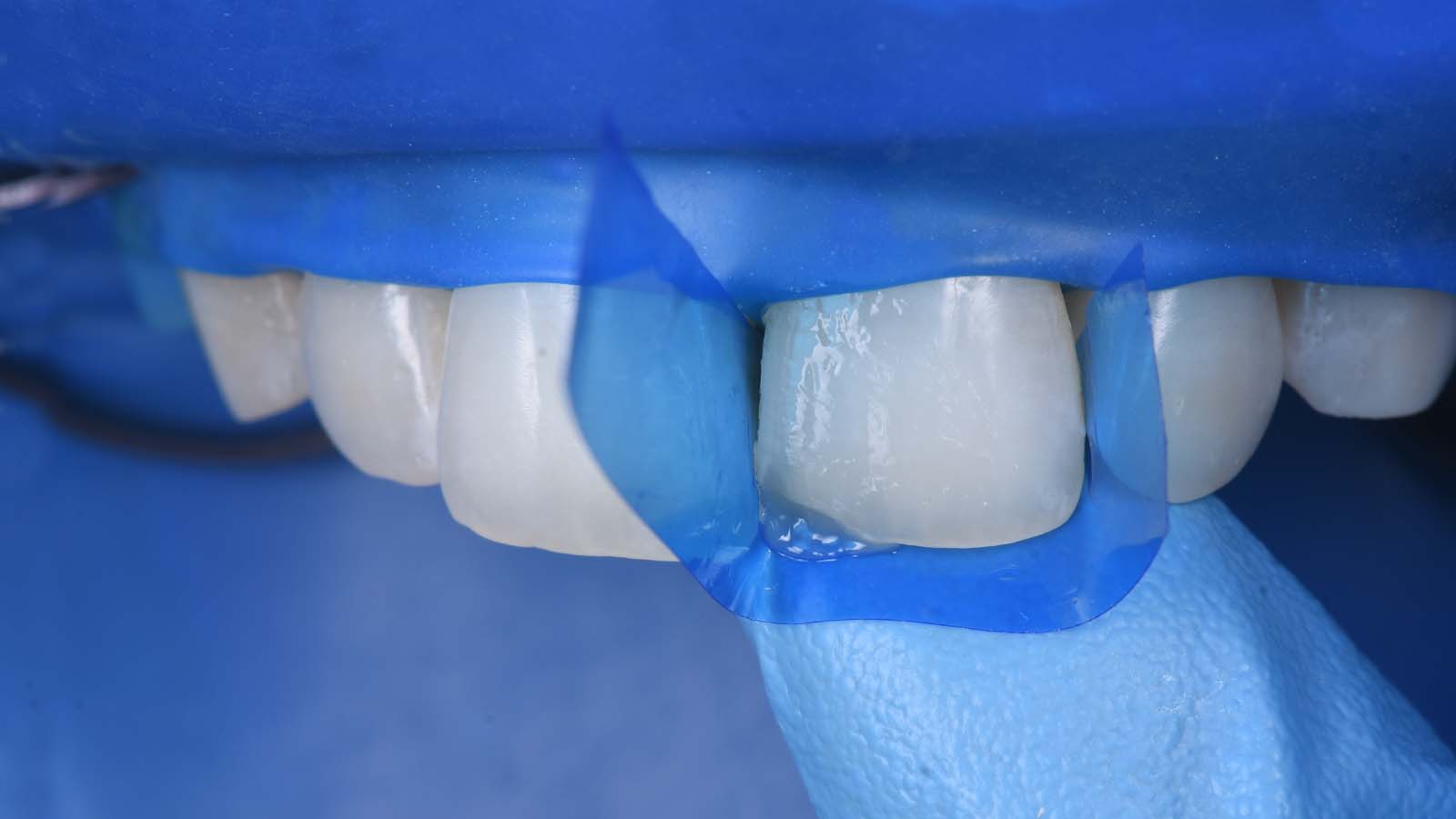 For small restorations, use a transparent matrix.