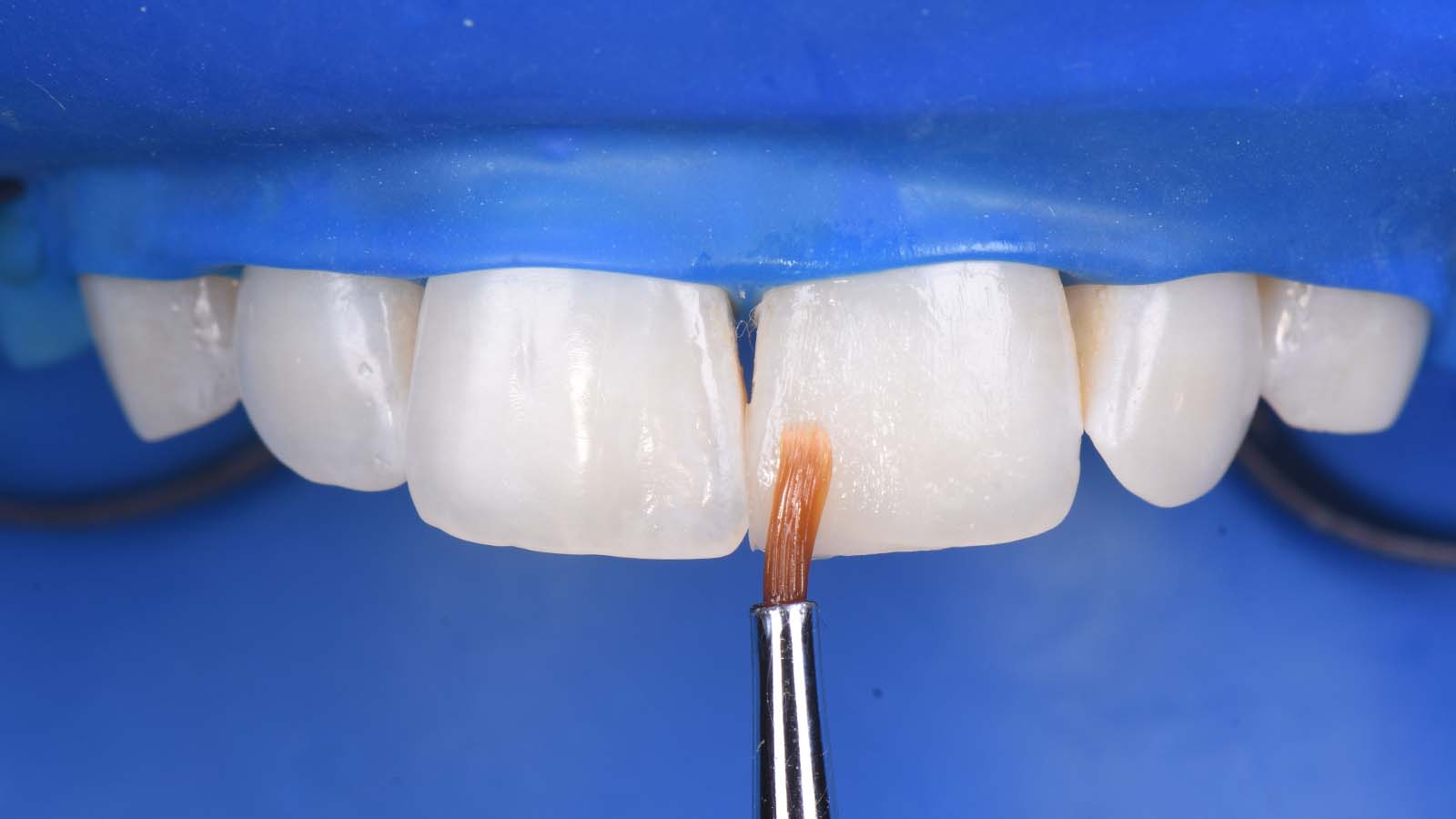 Build-up with the simplified composite shade, Venus Pearl LIGHT.