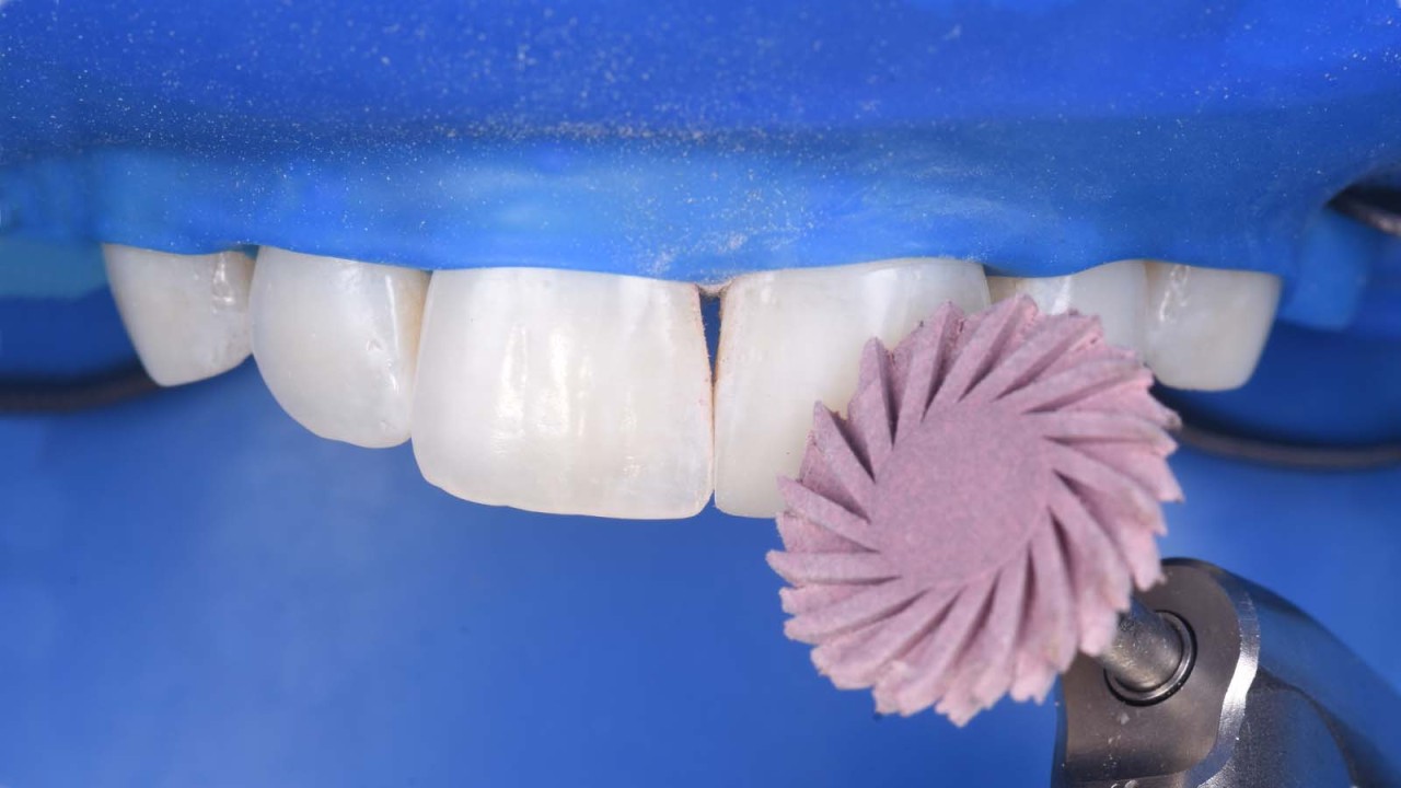 Polishing the buccal side with a different shape – the Venus Supra Twist Disc.