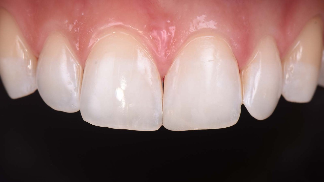 Immediate post-op result after polishing and removing the operative field. 