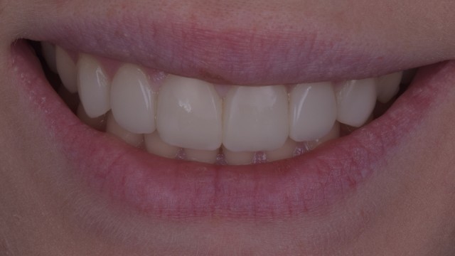 Result after 4 years, prior to a quick repolish